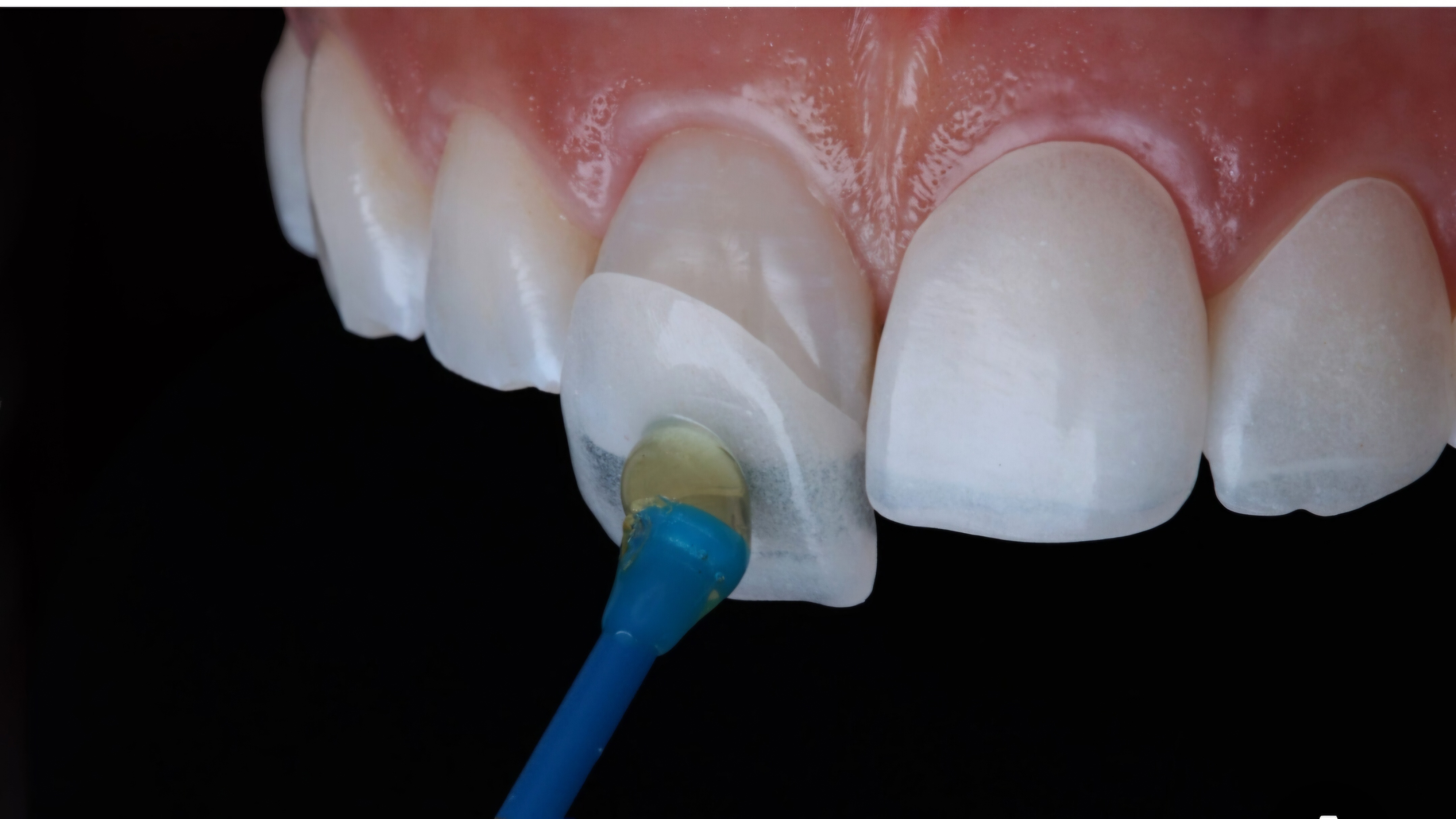 ציפוי חרסינה